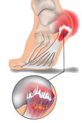 Plantar-1-deteriorated-foot-edited-267x400