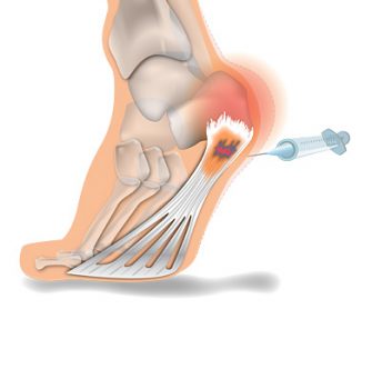 Plantar-2-PRP-injection