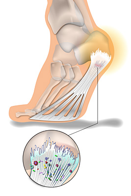 Plantar-4-Fibriosis-initiate-colagen-formation