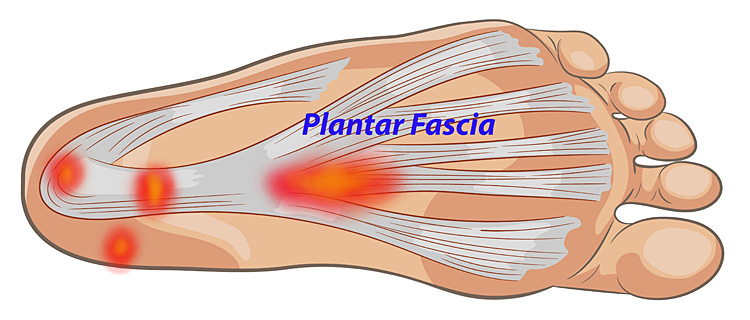 plantar-fasciitis_750